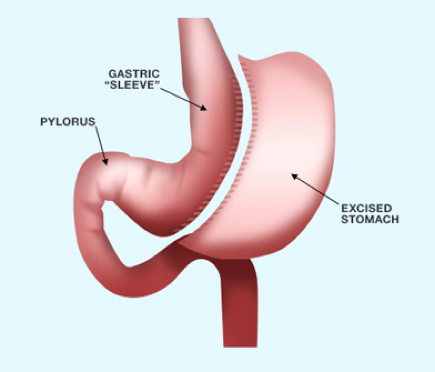 sleeve gastrectomy